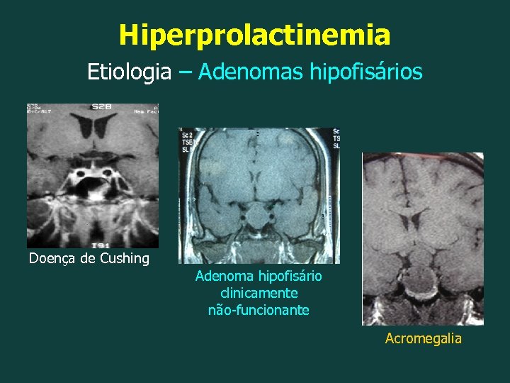 Hiperprolactinemia Etiologia – Adenomas hipofisários Doença de Cushing Adenoma hipofisário clinicamente não-funcionante Acromegalia 