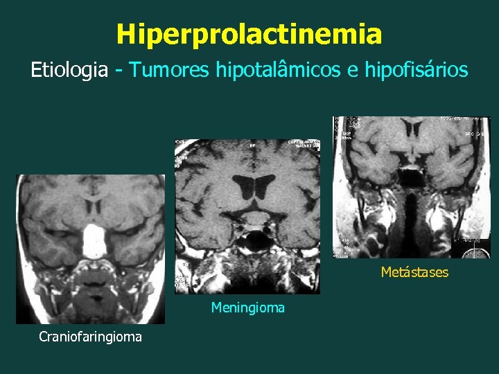 Hiperprolactinemia Etiologia - Tumores hipotalâmicos e hipofisários Metástases Meningioma Craniofaringioma 