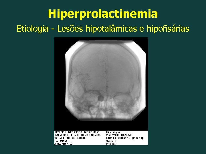 Hiperprolactinemia Etiologia - Lesões hipotalâmicas e hipofisárias 