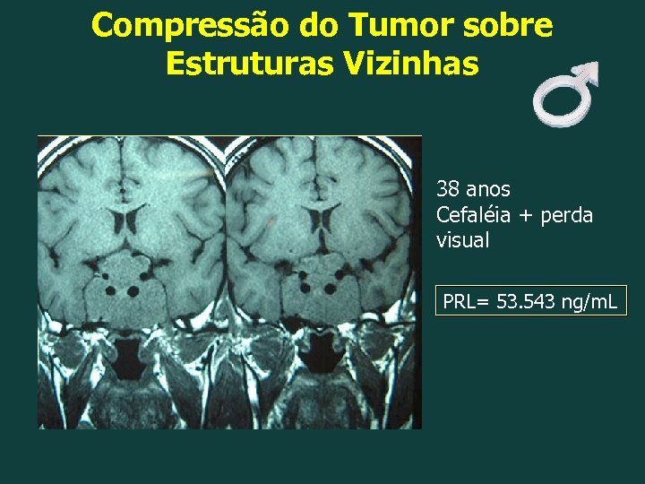 Compressão do Tumor sobre Estruturas Vizinhas 38 anos Cefaléia + perda visual PRL= 53.