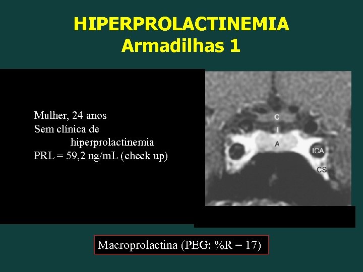 HIPERPROLACTINEMIA Armadilhas 1 Mulher, 24 anos Sem clínica de hiperprolactinemia PRL = 59, 2