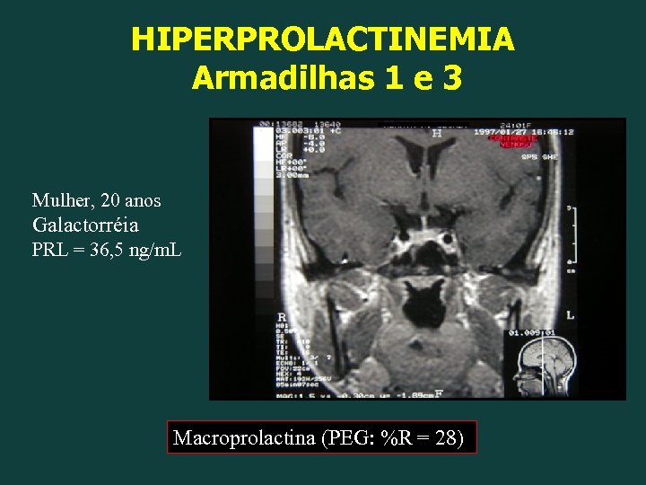 HIPERPROLACTINEMIA Armadilhas 1 e 3 Mulher, 20 anos Galactorréia PRL = 36, 5 ng/m.