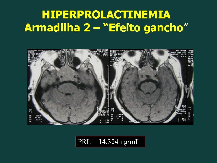 HIPERPROLACTINEMIA Armadilha 2 – “Efeito gancho” PRL = 14. 324 ng/m. L 