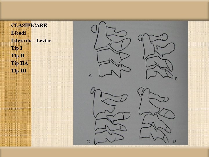 CLASIFICARE Efendi Edwards – Levine Tip IIA Tip III 