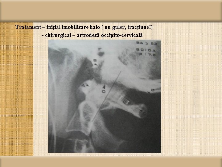 Tratament – iniţial imobilizare halo ( nu guler, tracţiune!) - chirurgical – artrodeză occipito-cervicală