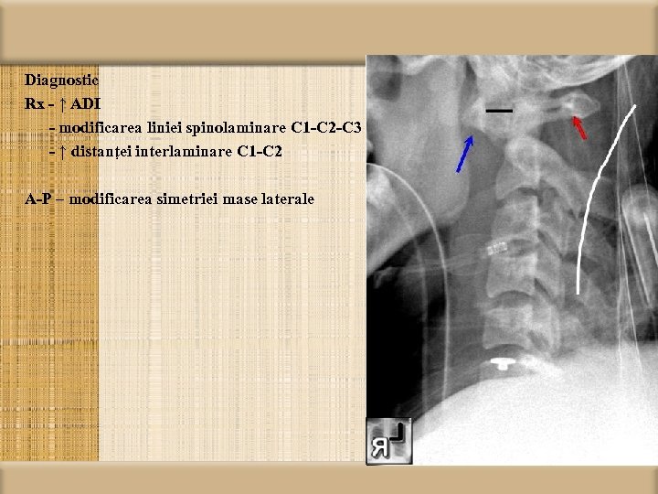Diagnostic Rx - ↑ ADI - modificarea liniei spinolaminare C 1 -C 2 -C