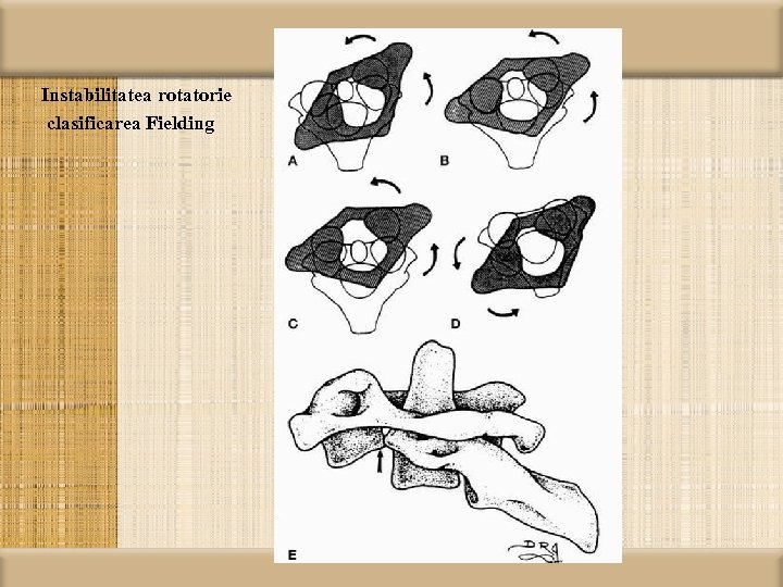 Instabilitatea rotatorie clasificarea Fielding 