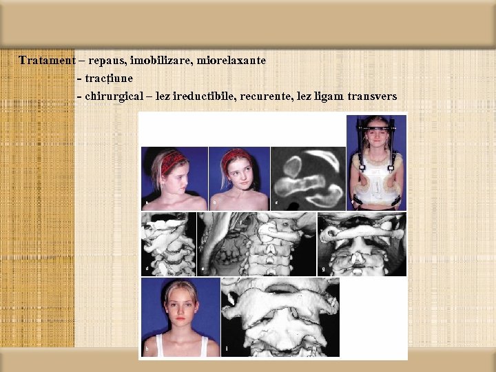 Tratament – repaus, imobilizare, miorelaxante - tracţiune - chirurgical – lez ireductibile, recurente, lez