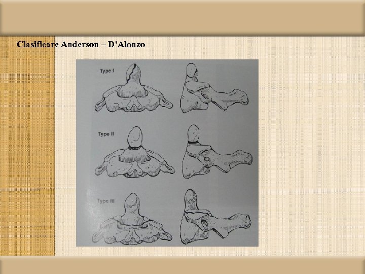 Clasificare Anderson – D’Alonzo 