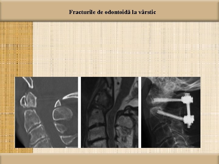 Fracturile de odontoidă la vârstic 