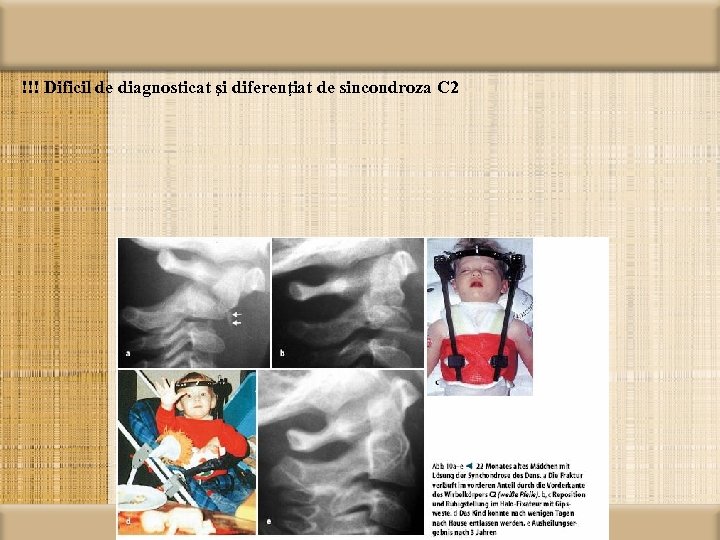 !!! Dificil de diagnosticat şi diferenţiat de sincondroza C 2 