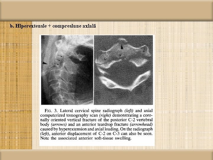 b. Hiperextensie + compresiune axială 