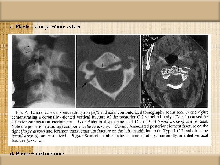c. Flexie + compresiune axială d. Flexie + distracţiune 
