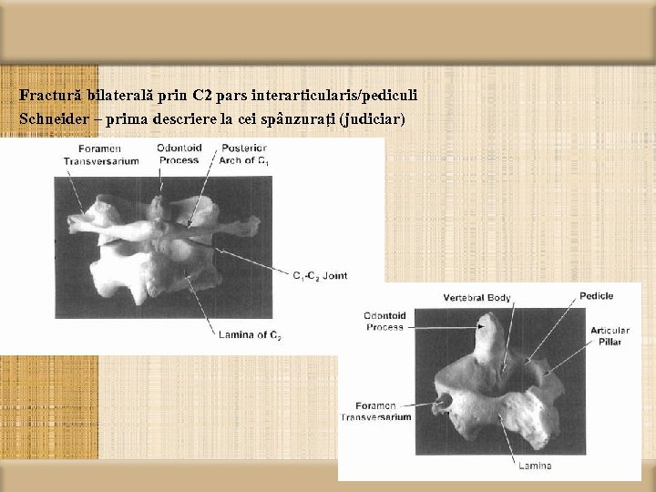 Fractură bilaterală prin C 2 pars interarticularis/pediculi Schneider – prima descriere la cei spânzuraţi