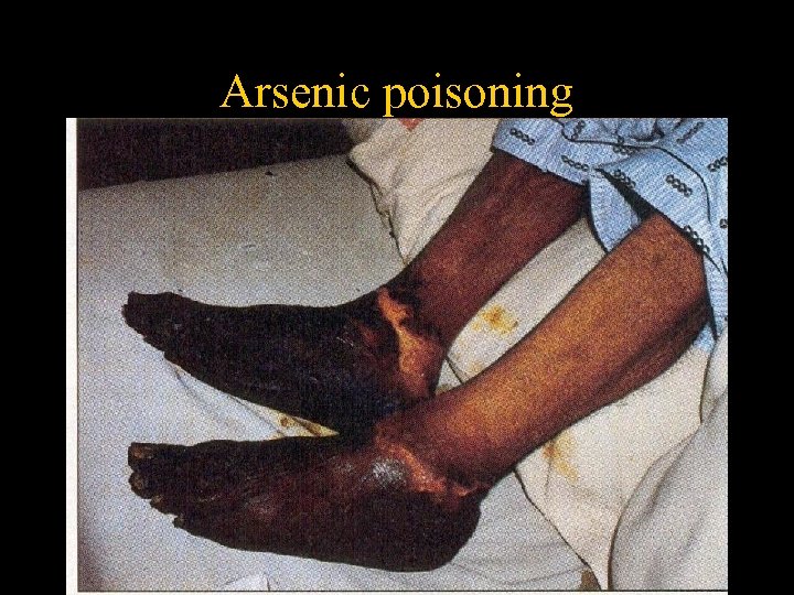 Arsenic poisoning 