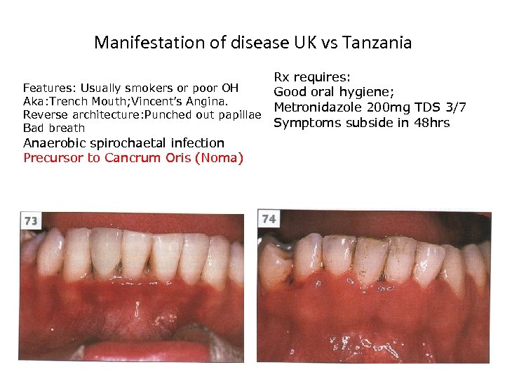 Manifestation of disease UK vs Tanzania Rx requires: Features: Usually smokers or poor OH