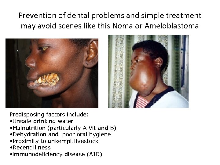 Prevention of dental problems and simple treatment may avoid scenes like this Noma or