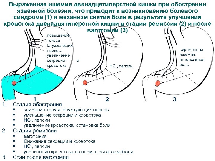 Ишемия кишки