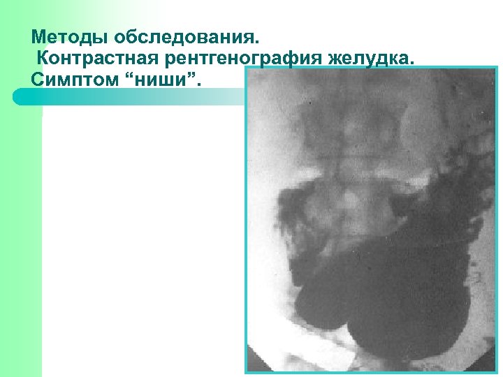 Методы обследования. Контрастная рентгенография желудка. Симптом “ниши”. 
