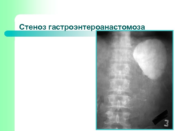 Стеноз гастроэнтероанастомоза 