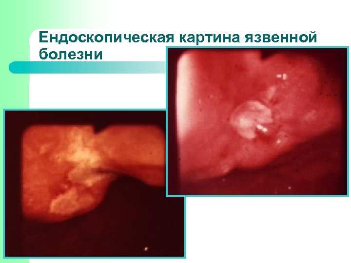 Ендоскопическая картина язвенной болезни 