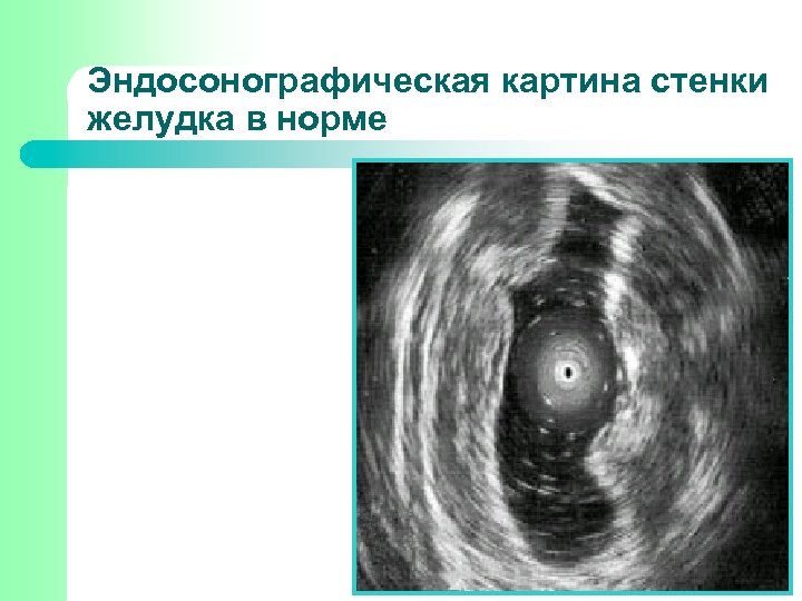 Эндосонографическая картина стенки желудка в норме 