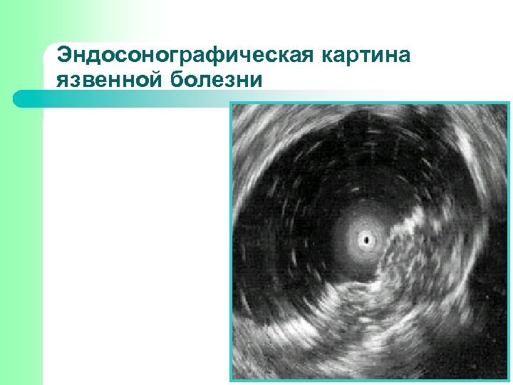 Эндосонографическая картина язвенной болезни 