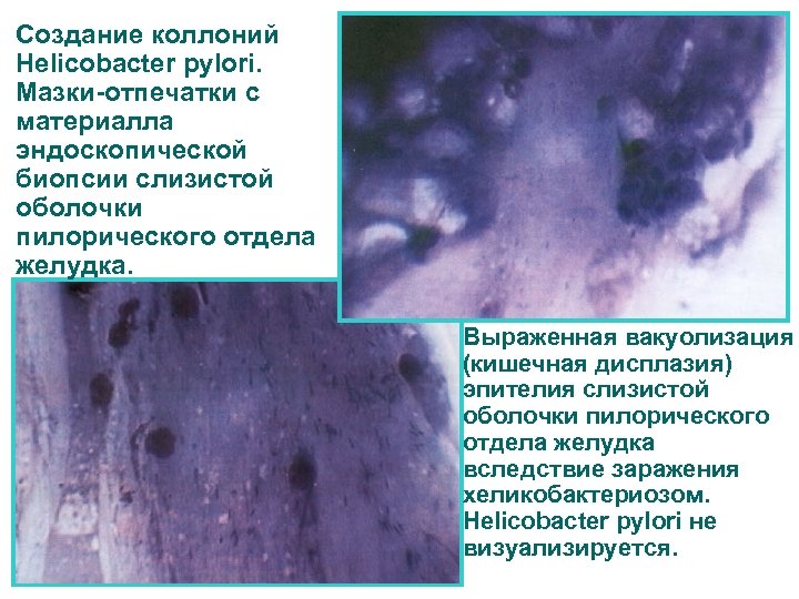Создание коллоний Helicobacter pylori. Мазки-отпечатки с материалла эндоскопической биопсии слизистой оболочки пилорического отдела желудка.