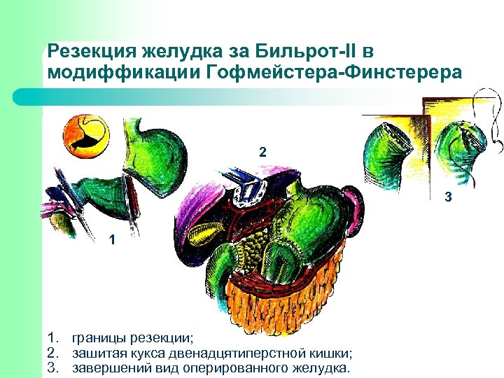 Резекция желудка за Бильрот-ІІ в модиффикации Гофмейстера-Финстерера 2 3 1 1. границы резекции; 2.