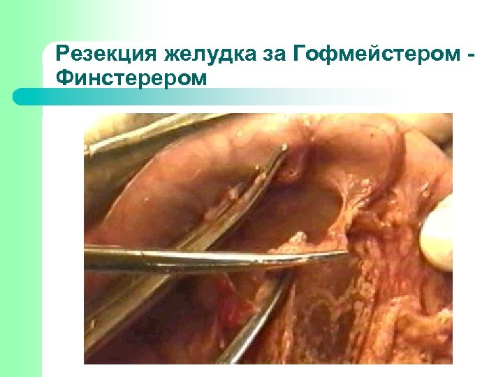 Резекция желудка за Гофмейстером Финстерером 