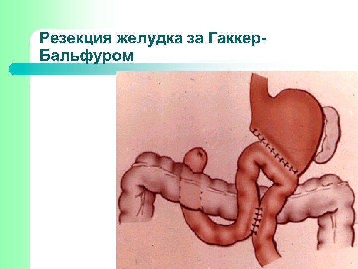 Резекция желудка за Гаккер. Бальфуром 