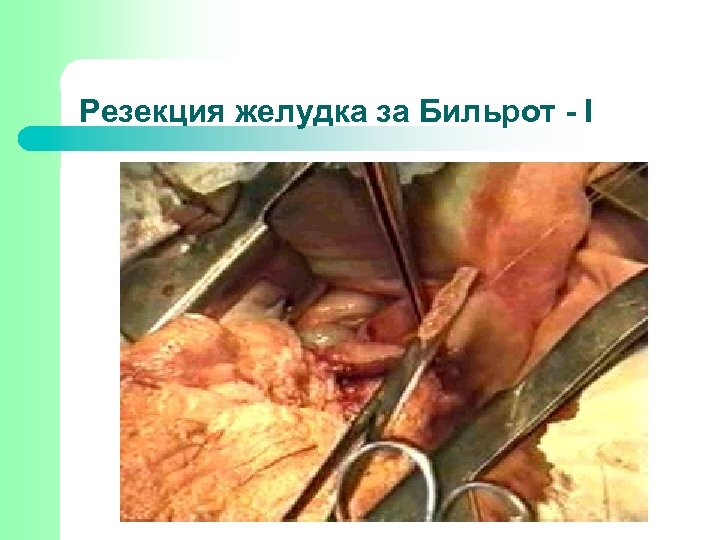 Резекция желудка за Бильрот - І 