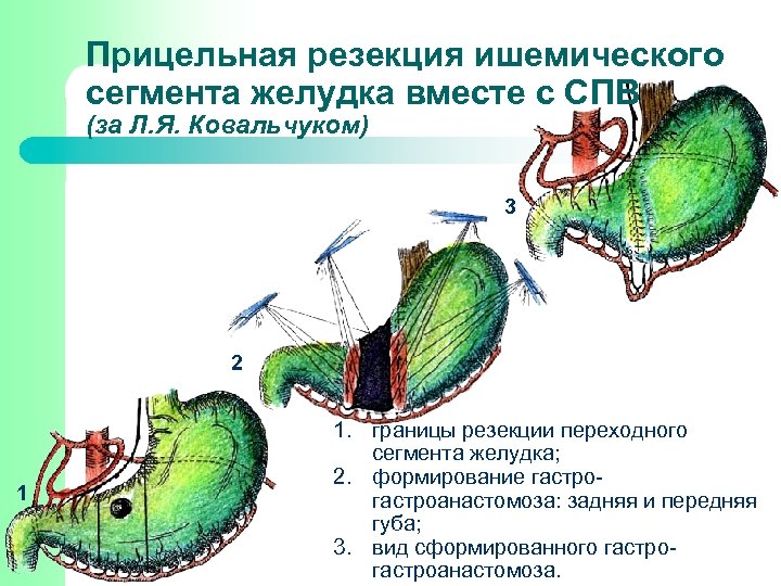 Прицельная резекция ишемического сегмента желудка вместе с СПВ (за Л. Я. Ковальчуком) 3 2