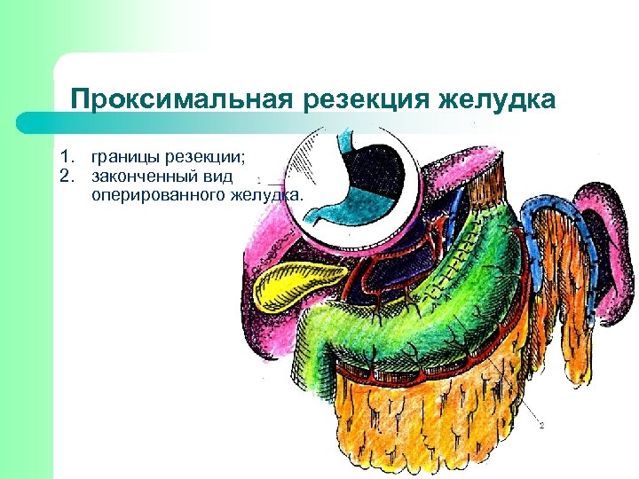 Проксимальная резекция желудка 1. границы резекции; 2. законченный вид оперированного желудка. 