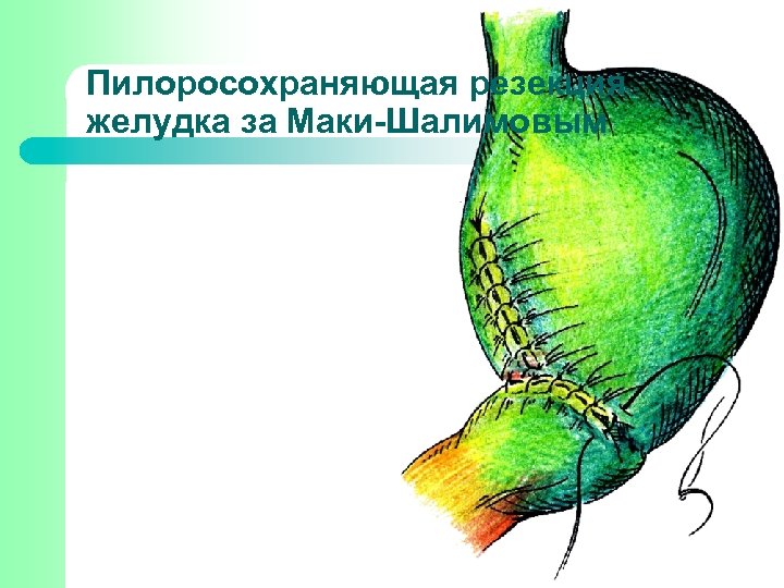 Пилоросохраняющая резекция желудка за Маки-Шалимовым 