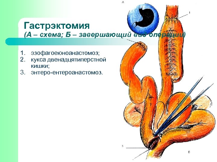 Гастрэктомия (А – схема; Б – завершающий вид операции) 1. эзофагоеюноанастомоз; 2. кукса двенадцятиперстной