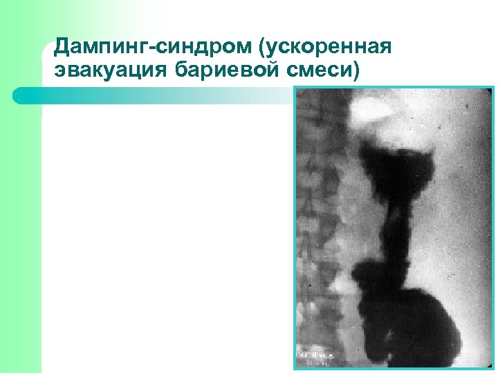 Дампинг-синдром (ускоренная эвакуация бариевой смеси) 