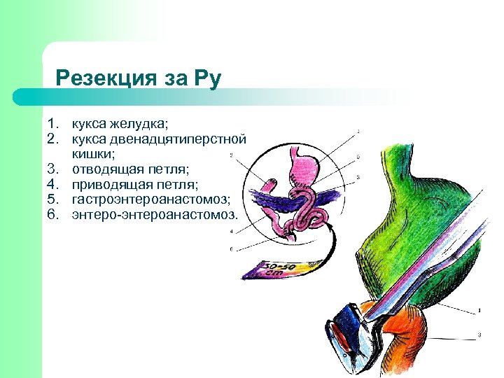 Резекция за Ру 1. кукса желудка; 2. кукса двенадцятиперстной кишки; 3. отводящая петля; 4.