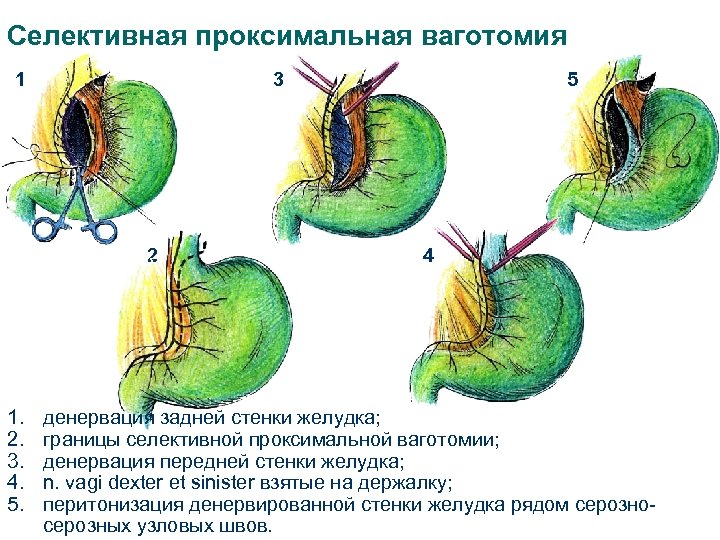 Селективная проксимальная ваготомия 1 3 2 1. 2. 3. 4. 5. 5 4 денервация