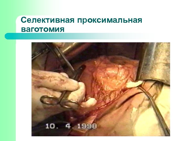 Селективная проксимальная ваготомия 