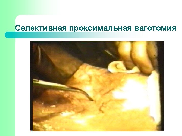 Селективная проксимальная ваготомия 