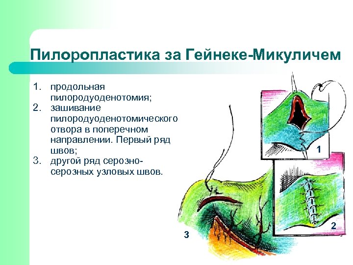 Пилоропластика по финнею схема