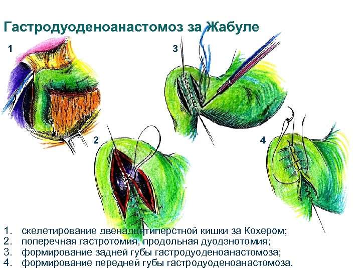 Гастродуоденоанастомоз за Жабуле 1 3 2 1. 2. 3. 4. 4 скелетирование двенадцятиперстной кишки