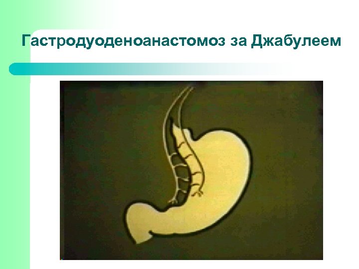 Гастродуоденоанастомоз за Джабулеем 