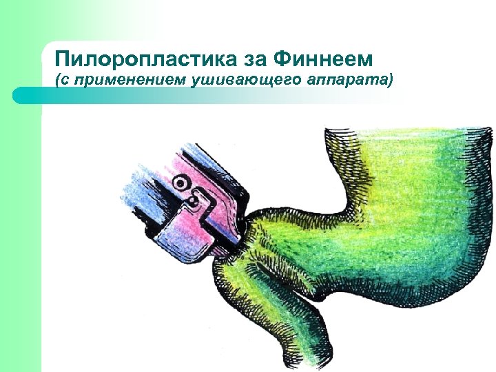 Пилоропластика за Финнеем (с применением ушивающего аппарата) 