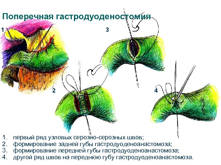 Поперечная гастродуоденостомия 1 3 2 1. 2. 3. 4. 4 первый ряд узловых серозно-серозных