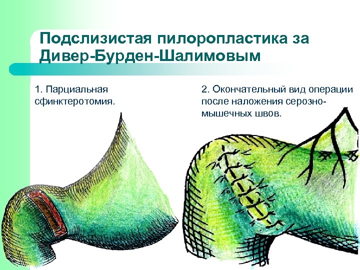 Окончательный вид. Пилородуоденопластика. Виды пилоропластики с.картинками.