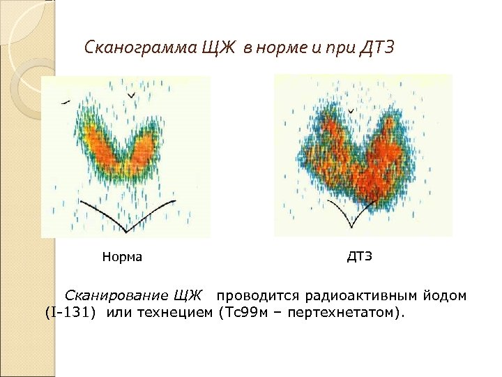 Сканограмма ЩЖ в норме и при ДТЗ Норма ДТЗ Сканирование ЩЖ проводится радиоактивным йодом