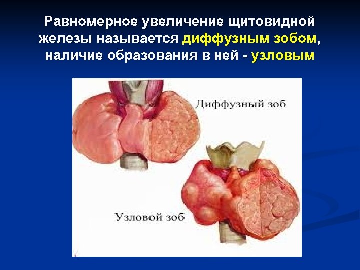 Равномерное увеличение щитовидной железы называется диффузным зобом, наличие образования в ней - узловым 