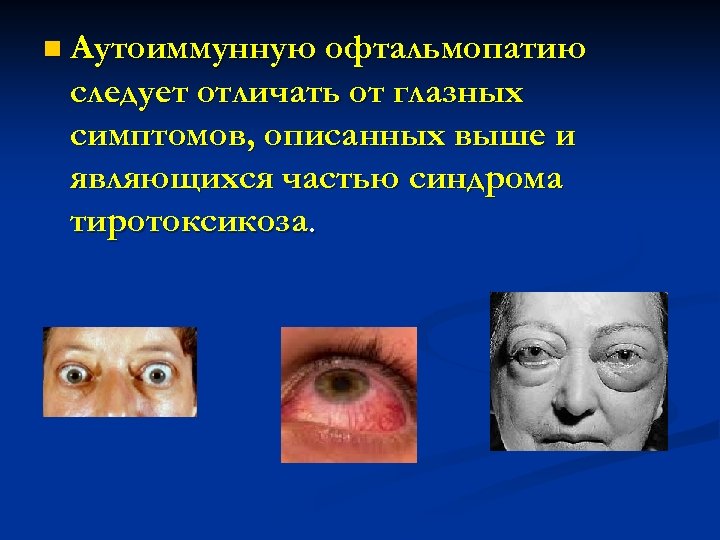 n Аутоиммунную офтальмопатию следует отличать от глазных симптомов, описанных выше и являющихся частью синдрома